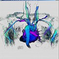 Medical Visualization of a MR Angiography with TTP-Color-Coding