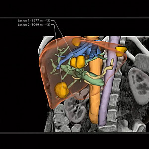 AI Based Segmentation, Siemens Healthineers, Forchheim