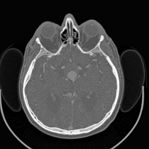 CT Angiography