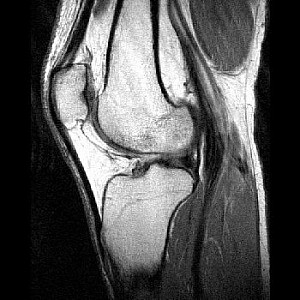 MRI-Shadowing