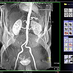 Syngo-Abdomen-MIP