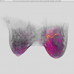 Tumor-MIPt-GradMag