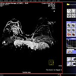 Syngo-Breast-VRT